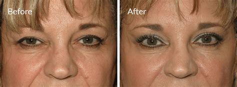 eyesthetica torrance|Torrance Eyelid Surgery Near You